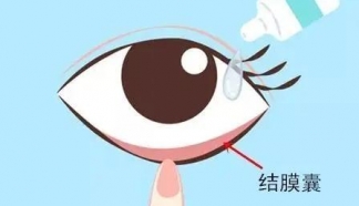 疫情期間，近視手術(shù)術(shù)后應(yīng)該如何保養(yǎng)?