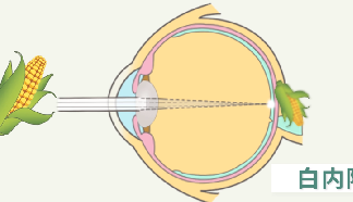 臺(tái)州白內(nèi)障專科-白內(nèi)障相關(guān)小知識(shí)一覽