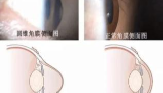 度數(shù)長(zhǎng)得快，有時(shí)候并不是近視的原因哦！